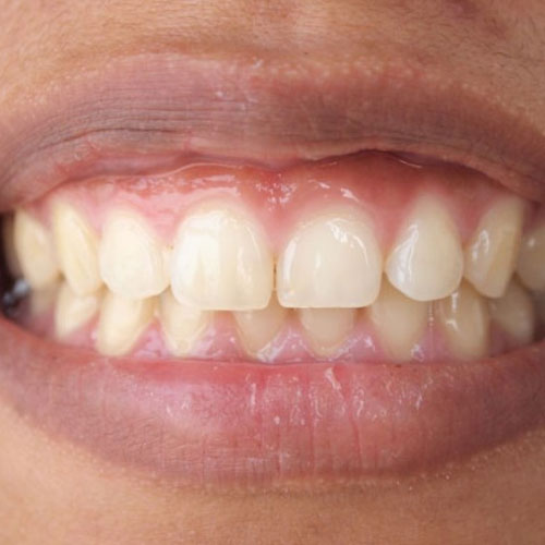 Gum Discoloration in South Delhi,Gum Discoloration Treatment in Friends