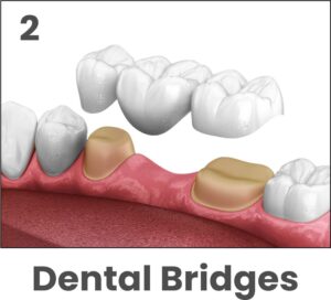 Dental Bridges.