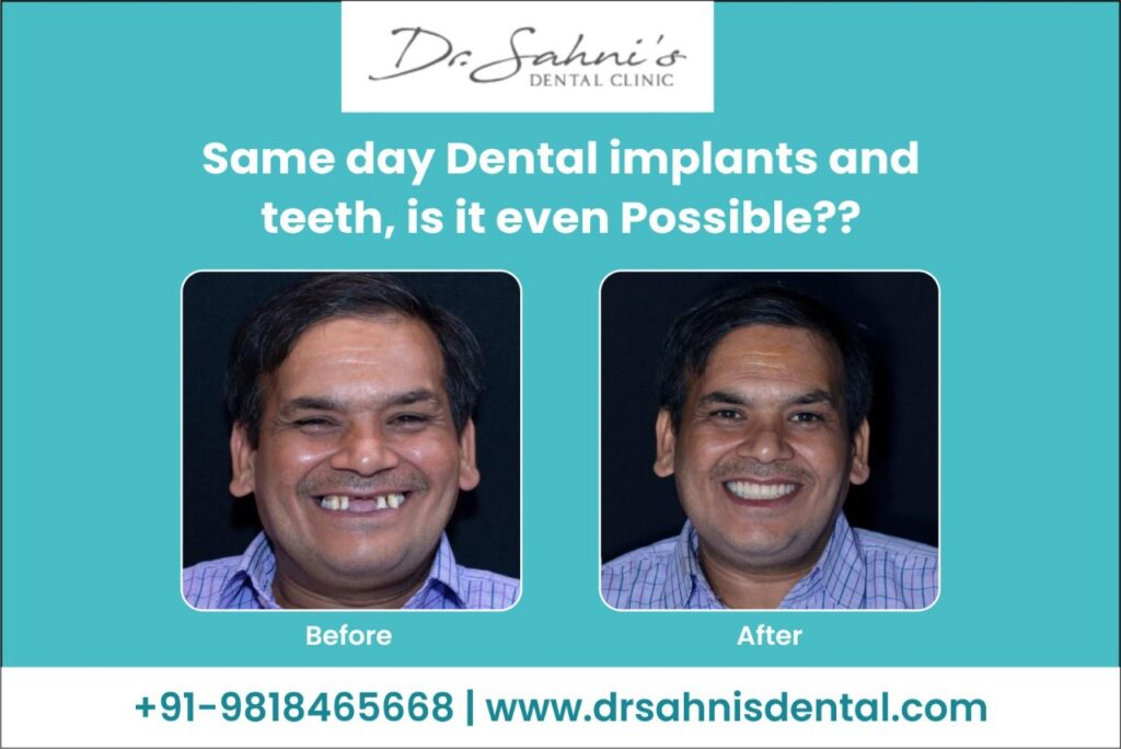 Same day Dental implants and teeth