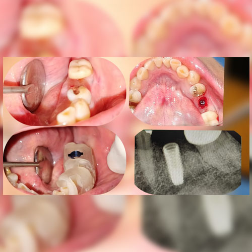 3D Computer Guided Implant Surgery