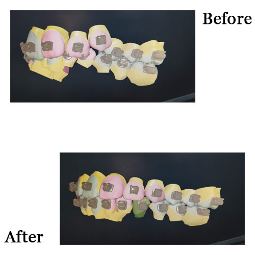 3D Computer guided Braces