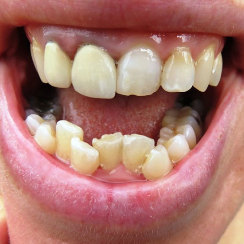 Crooked Teeth Correction