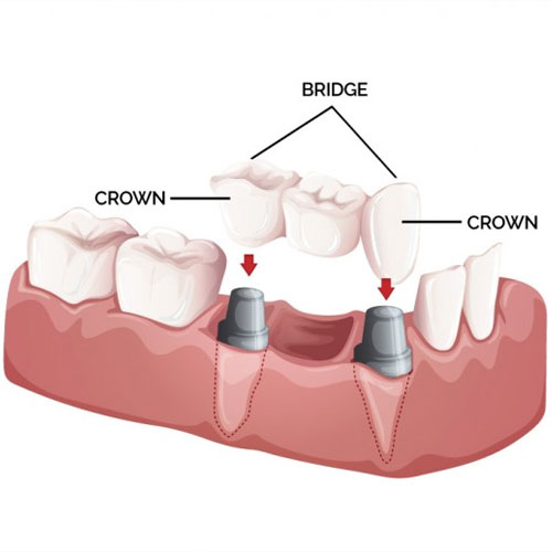 Crowns and Bridges