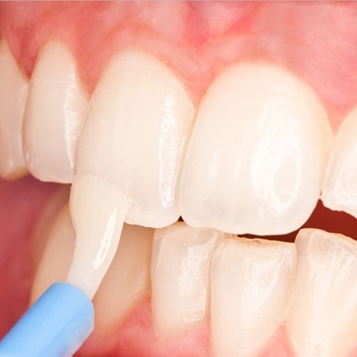 Fluoride Application