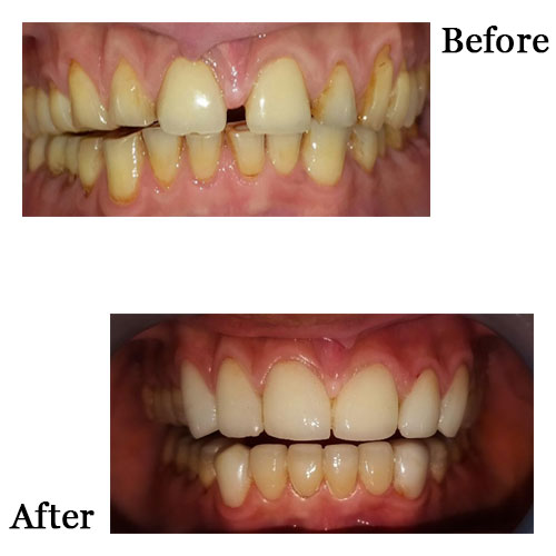 Full Mouth Rehabilitation