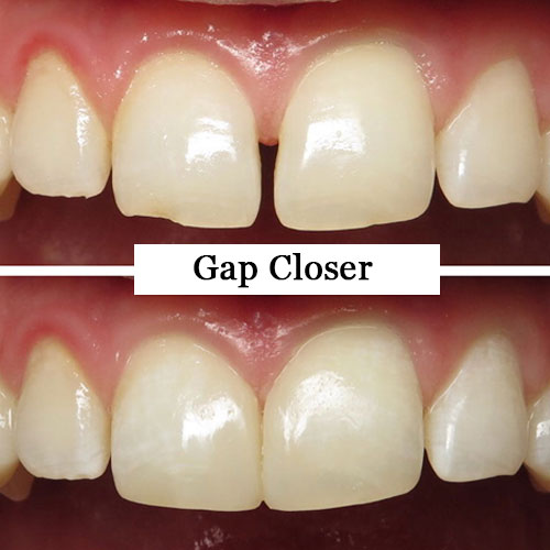 Gap Closure