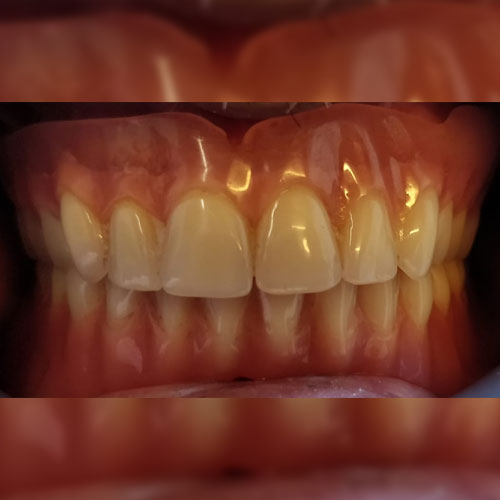 Geriatric Care/Dentures