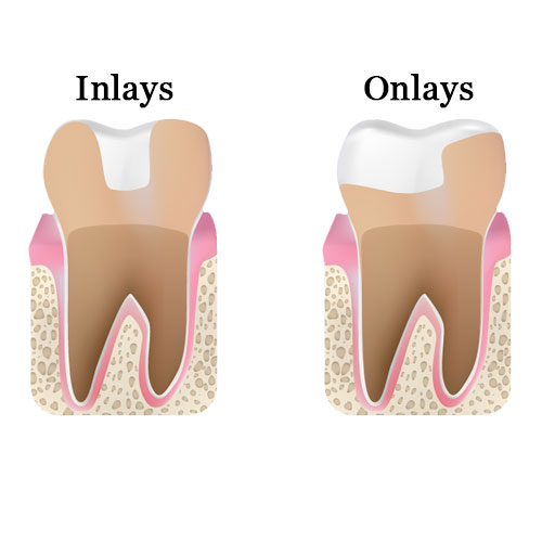 Inlays and Onlays