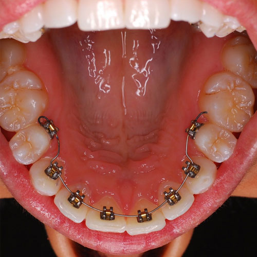 Lingual Braces