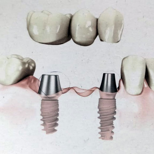 Multiple Teeth Implant
