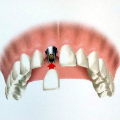 Single Tooth Implant