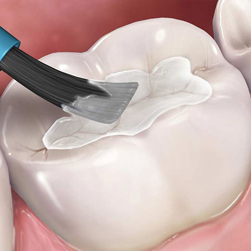 Tooth Sealants