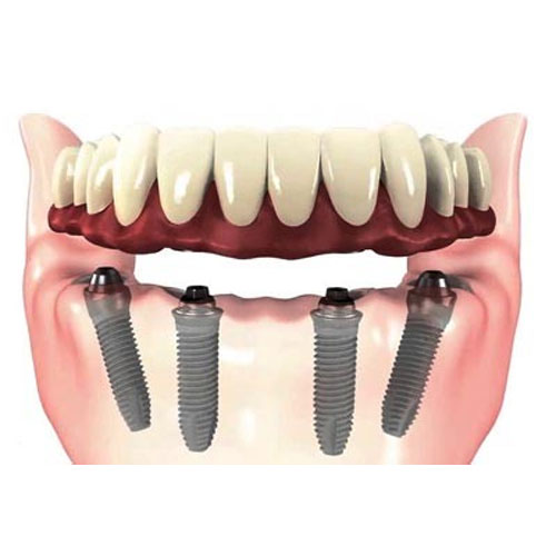 Dental Implants