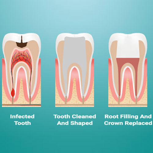 Root Canal Treatment