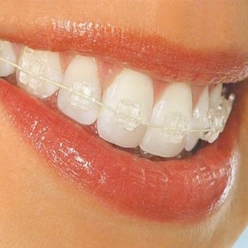 Metallic and Tooth colored Braces