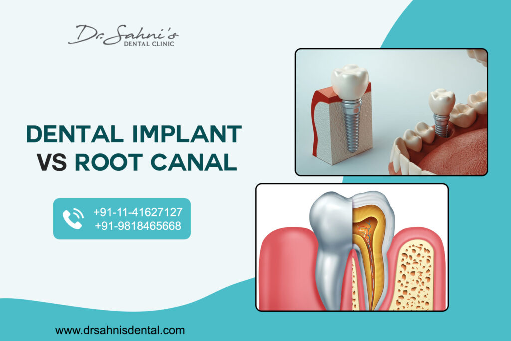 Dental Implant or Root Canal