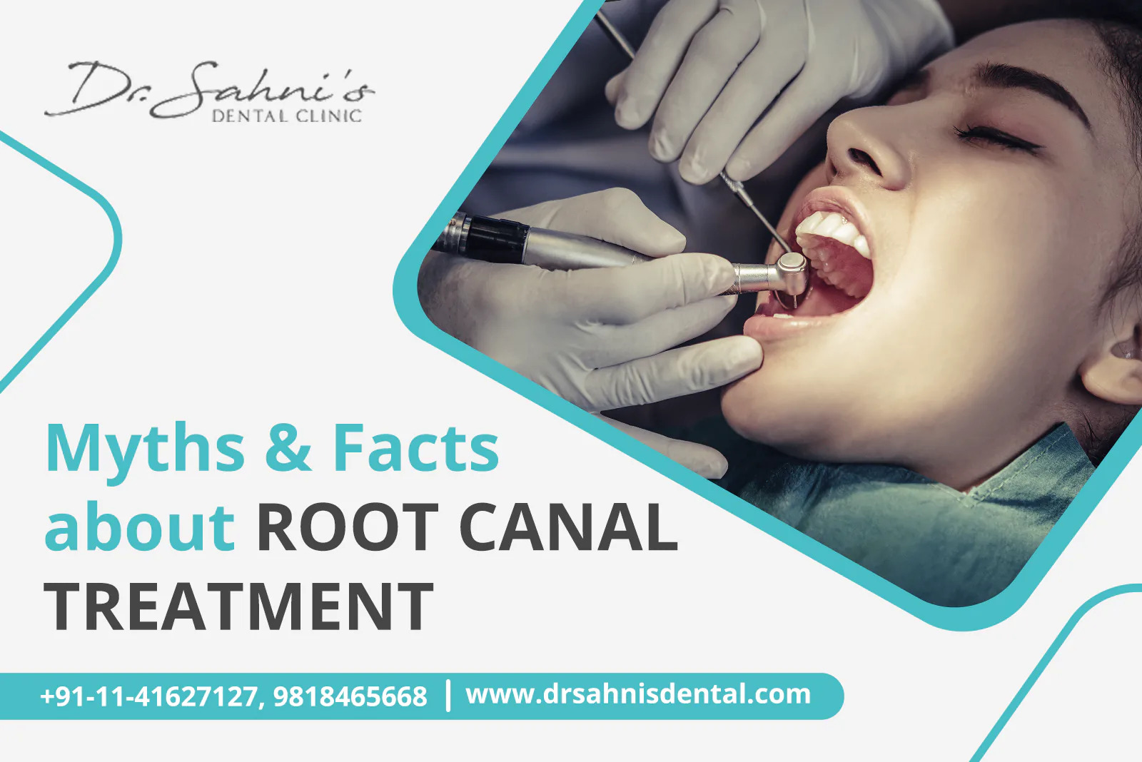 root canal treatment in delhi