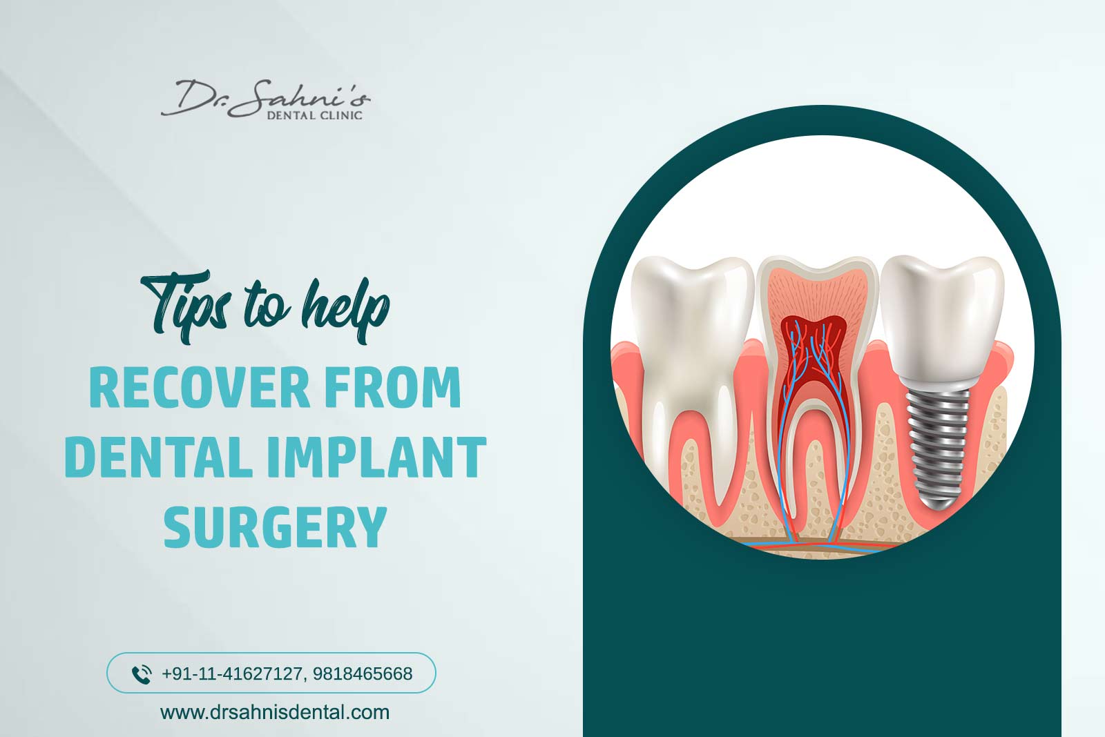 dental implants surgery tips