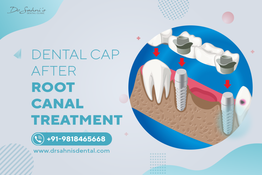 capping after root canal treatment