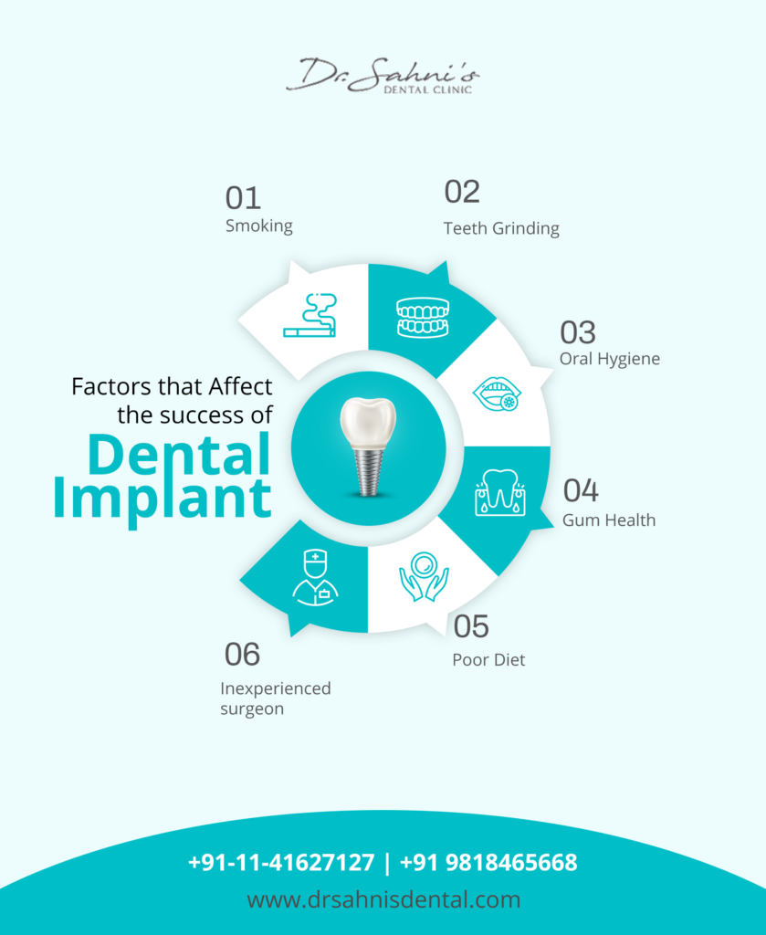 do-dental-implants-last-forever-how-long-do-dental-implants-last