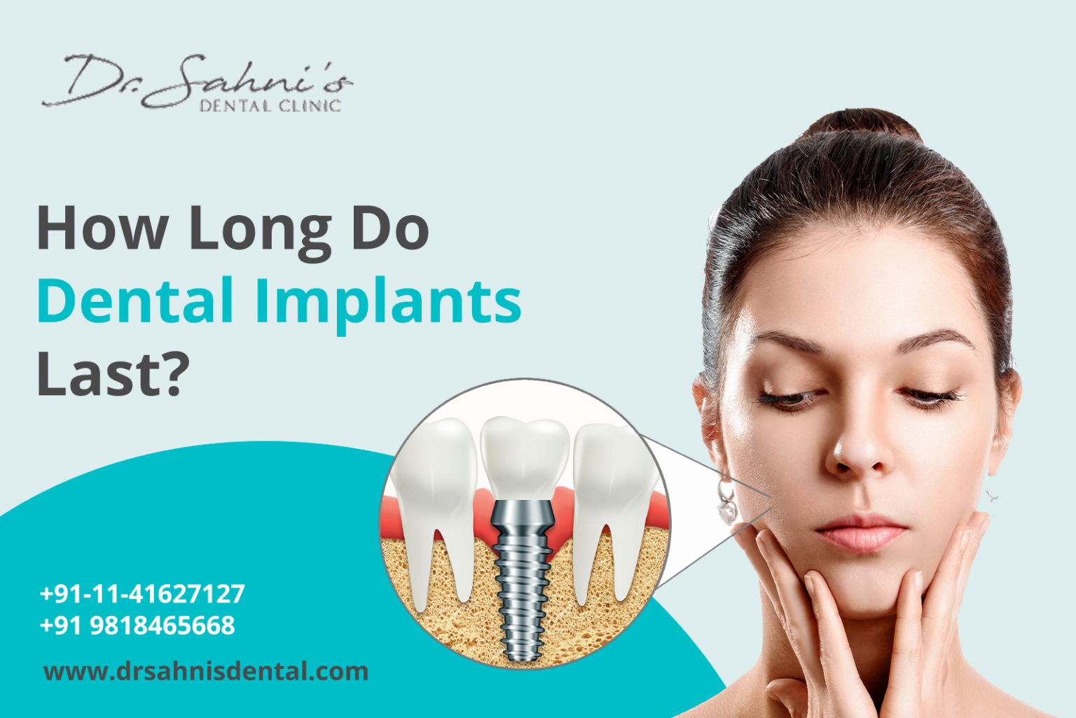 Do Dental Implants Last Forever How long do Dental Implants Last?
