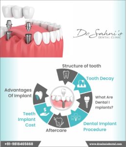 Important Facts About Dental Implants