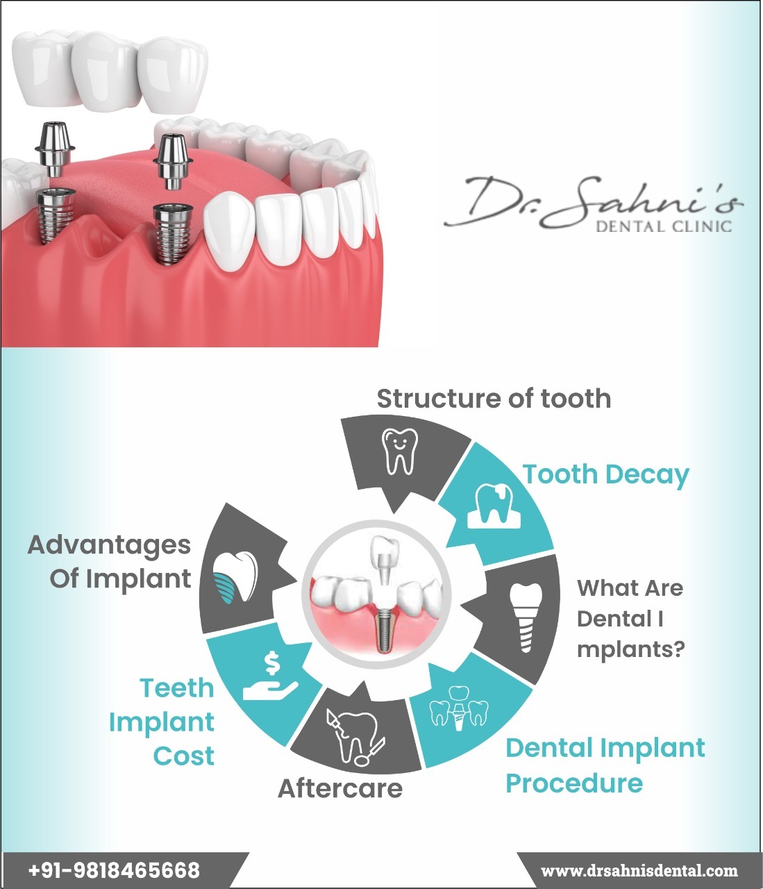Important Facts About Dental Implants Dr Sahni Dental