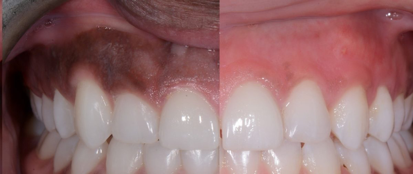 Gum Discoloration