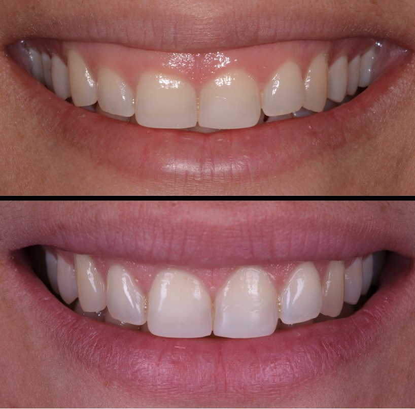 Laser Gummy Smile Correction